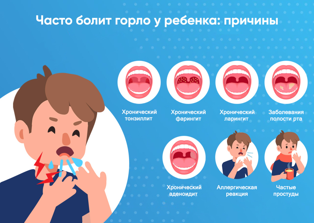 Часто болит горло у ребенка: причины